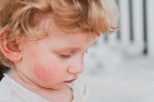Vitamin D Eczema: Is There a Connection?